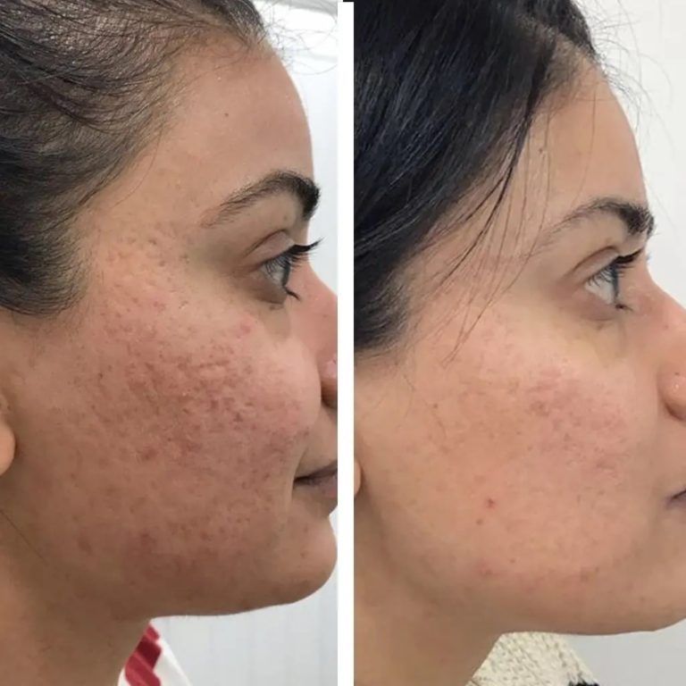 Microneedling at Fancy Face Skin Clinics